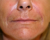 Feel Beautiful - Filler in Nasal Labial Folds-Creases San Diego - After Photo